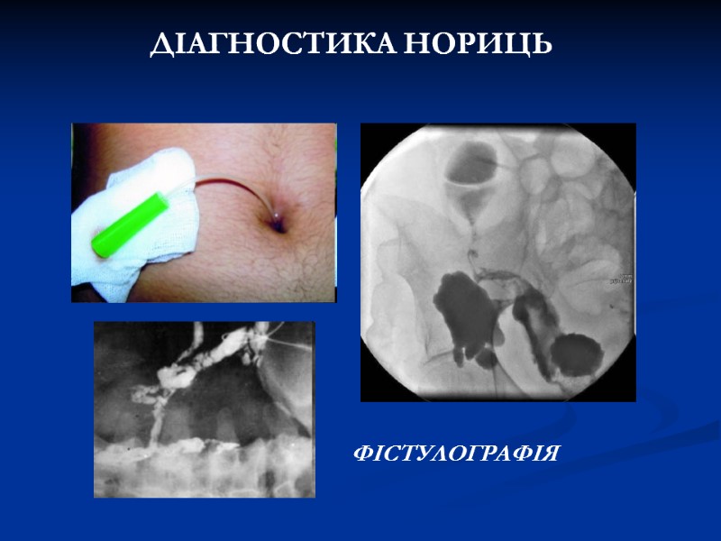 ДІАГНОСТИКА НОРИЦЬ ФІСТУЛОГРАФІЯ ДІАГНОСТИКА НОРИЦЬ ФІСТУЛОГРАФІЯ